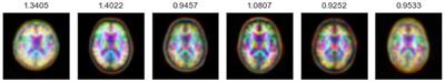 DeepAD: A deep learning application for predicting amyloid standardized uptake value ratio through PET for Alzheimer's prognosis